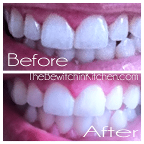 Teeth whitening system